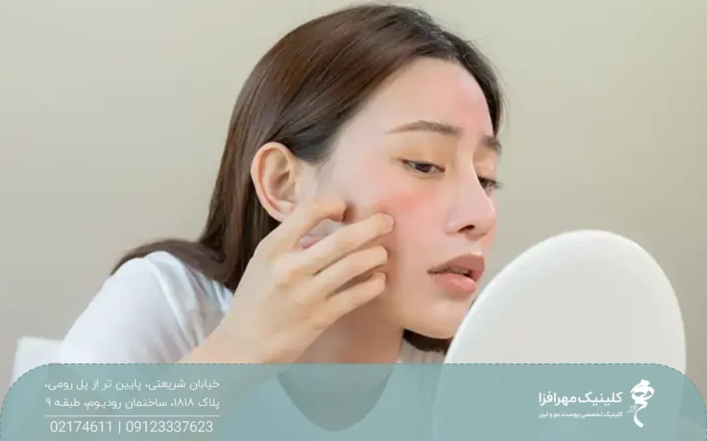 دختری که دچار خارش و قرمزی پوست شده است و صورت خود را در آینه می بیند و گونه خود را می خاراند