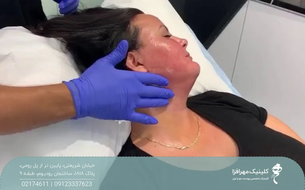 زنی که دراز کشیده و صورت خود را به یک طرف چرخانده و پوست صورت و غبغب او قرمز و متورم است و پزشک در حال ماساژ صورت او است