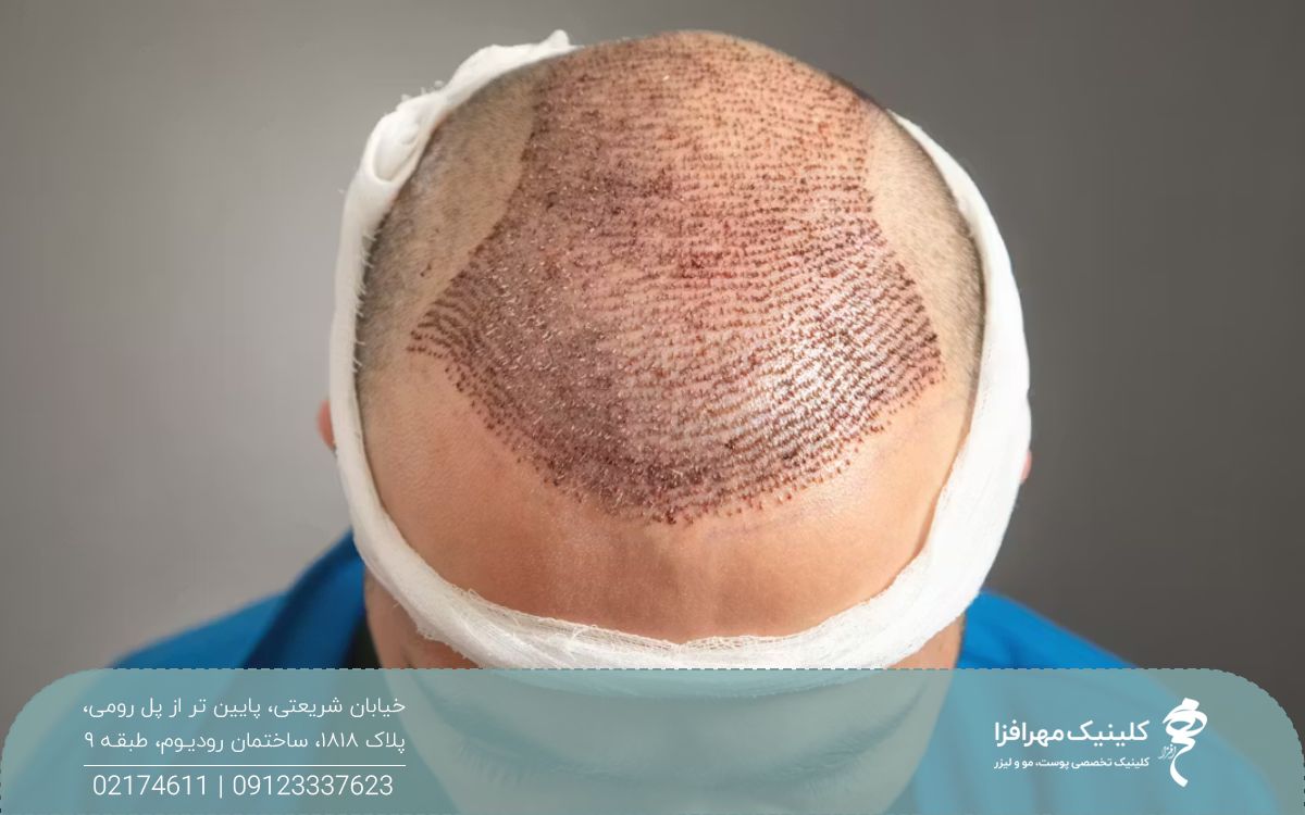مردی که کاشت مو انجام داده و کف سر او قرمز شده و دور سر او و روی بانک مو باند پیچیده شده است