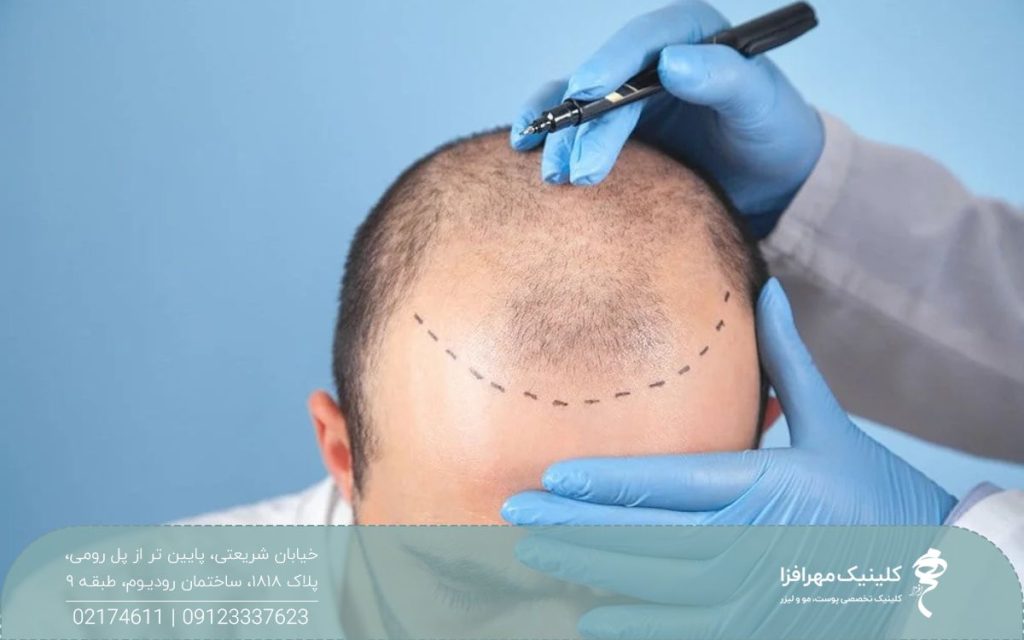 مردی که سر او طاس است و پزشک با ماژیک کف سر او طراحی می کند
