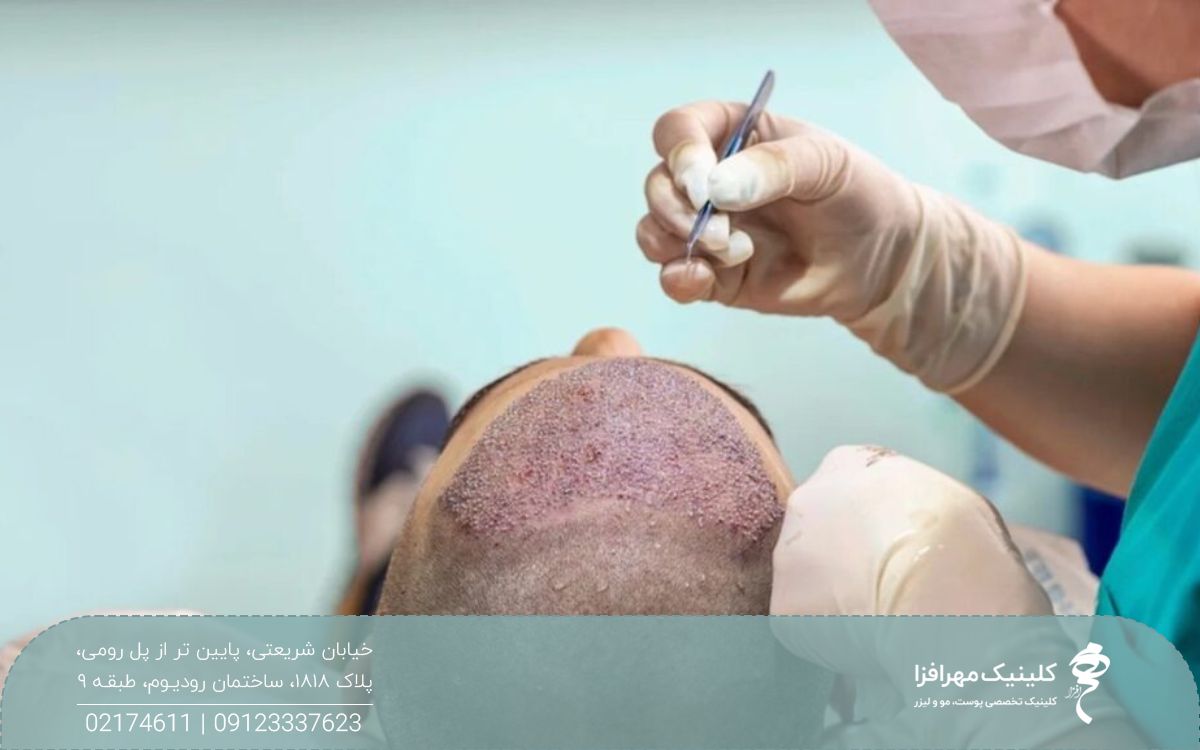 مردی که روی تخت کلینیک دراز کشیده است و پزشک در حال پیوند فولکیول های مو به جلوی سر او است