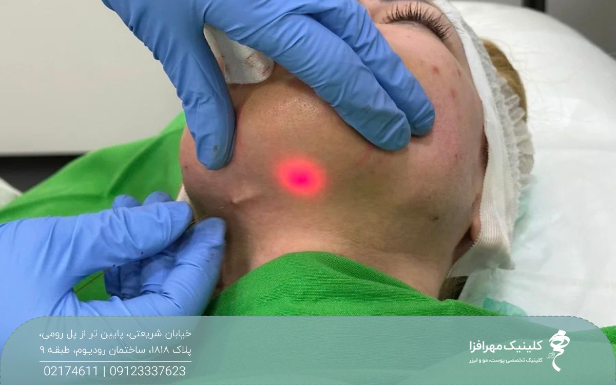 پزشکی که گردن و زیر چانه را اندولیفت می کند