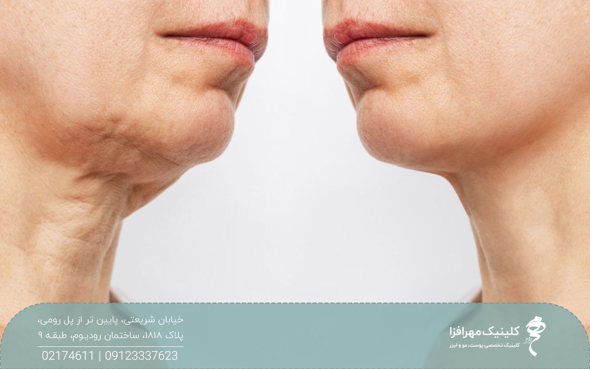 عکس یک گردن با پوست پیر و افتاده و یک گردن جوان