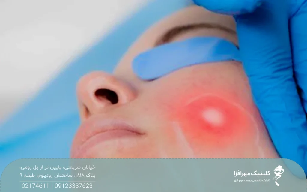 زنی که روی چشم و سرش پوشیده است و دستان دکتری که در حال انجام اندولیفت روی سمت چپ صورت او است
