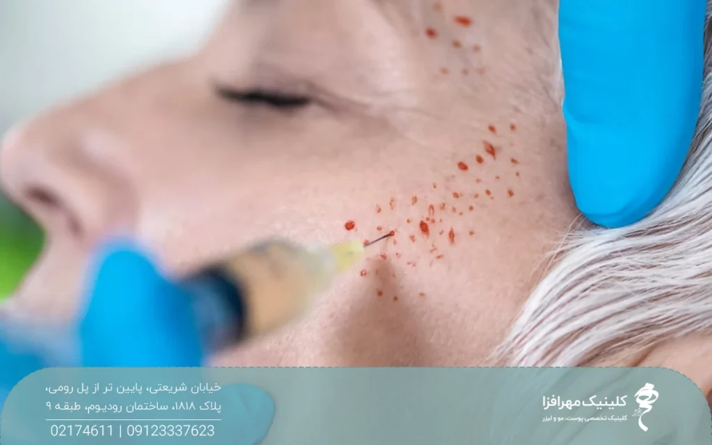 قسمتی از شقیقه دختر که پزشک آن ناحیه را پی آر پی می کند