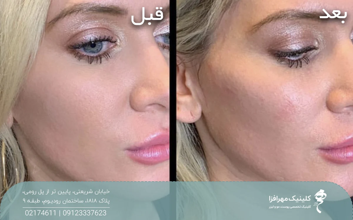 عکس قبل و بعد زنی که تزریق ژل گونه انجام داده است