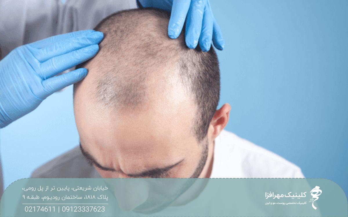 مردی که موهای سر او کم پشت و کوتاه است و پزشک موهای او را معاینه می کند