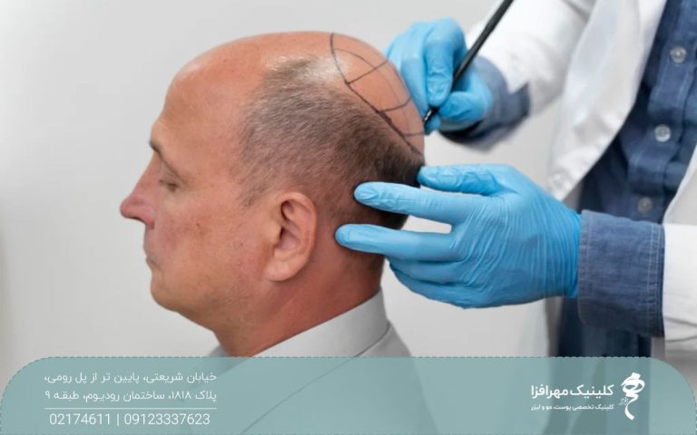 پزشکی که پشت سر مرد طاس ایستاده است و با مداد روی سر او طراحی انجام می دهد