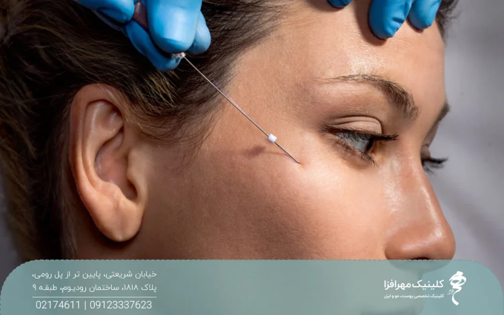 عکس نیم رخ از صورت دختری که پزشک نخ لیفت را وارد پوست او می کند