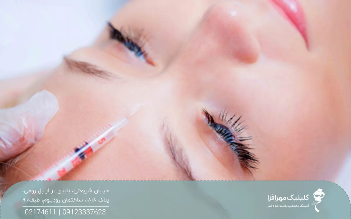 دختری که دراز کشیده و پزشک سرنگ فیلر را بین دو ابروی او گذاشته است