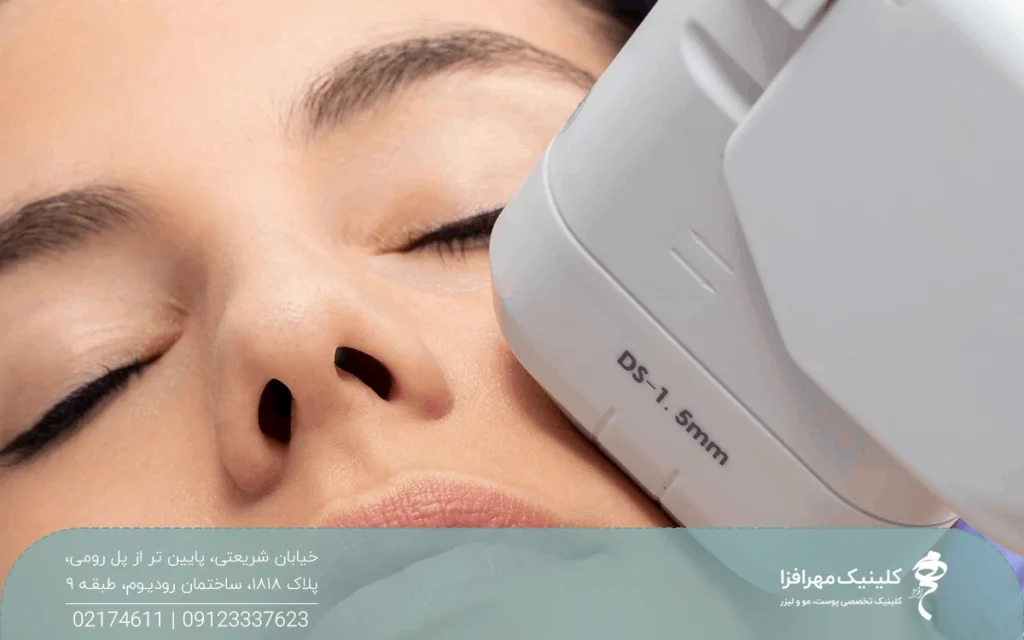 دختری که چشمان او بسته است و هندپیس دستگاه هایفوتراپی روی سمت چپ صورت او قرار دارد