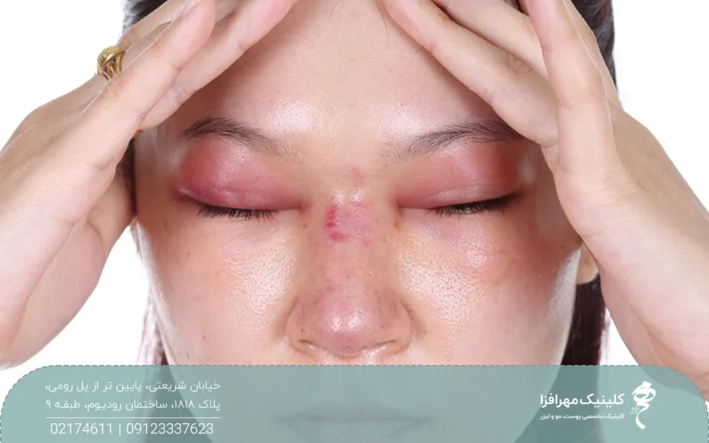 دختری که به نشانه درد دست هایش را روی پیشانی اش گذاشته و چشم ها و بینی اش قرمز و متورم شده است