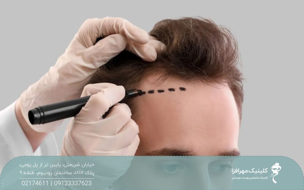 مردی که موهای او در ناحیه شقیقه کم پشت است و پزشک خط رویش او را با ماژیک مشکی مشخص می کند
