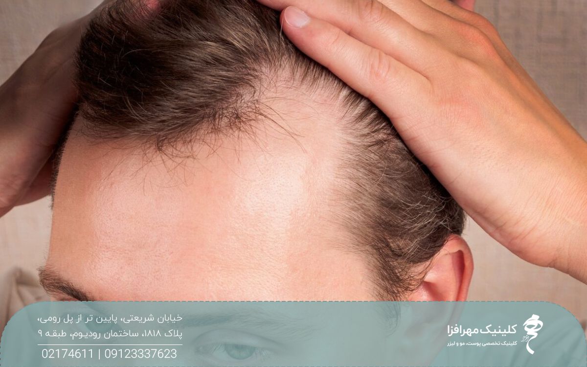 مردی که موهای خود را به عقب کشیده و موهای او در ناحیه شقیقه کم پشت شده است