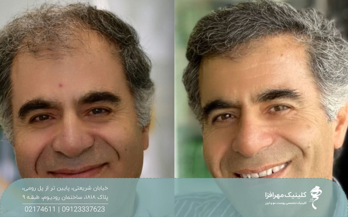 عکس قبل و بعد مردی که کاشت مو انجام داده و موهای او در خط رویش و شقیقه پرپشت تر شده است