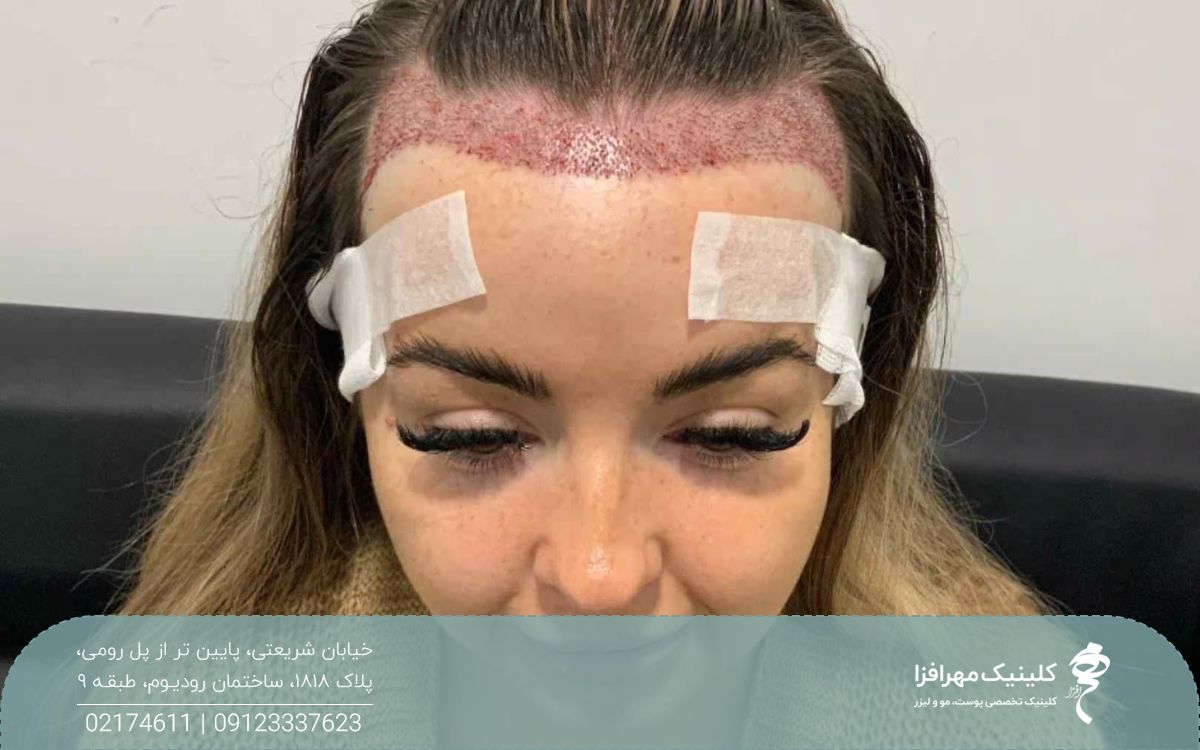 زنی که خط رویش او به سمت عقب رفته و در این ناحیه کاشت انجام داده است