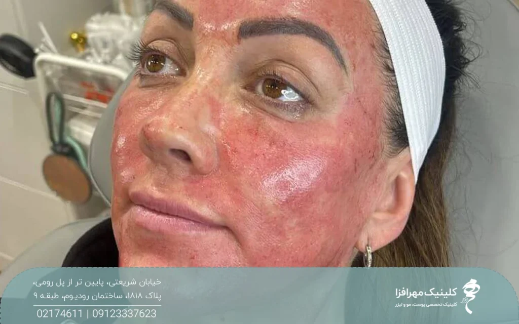 صورت خانمی که پی آر پی انجام داده است و پوست او قرمز و متورم شده است