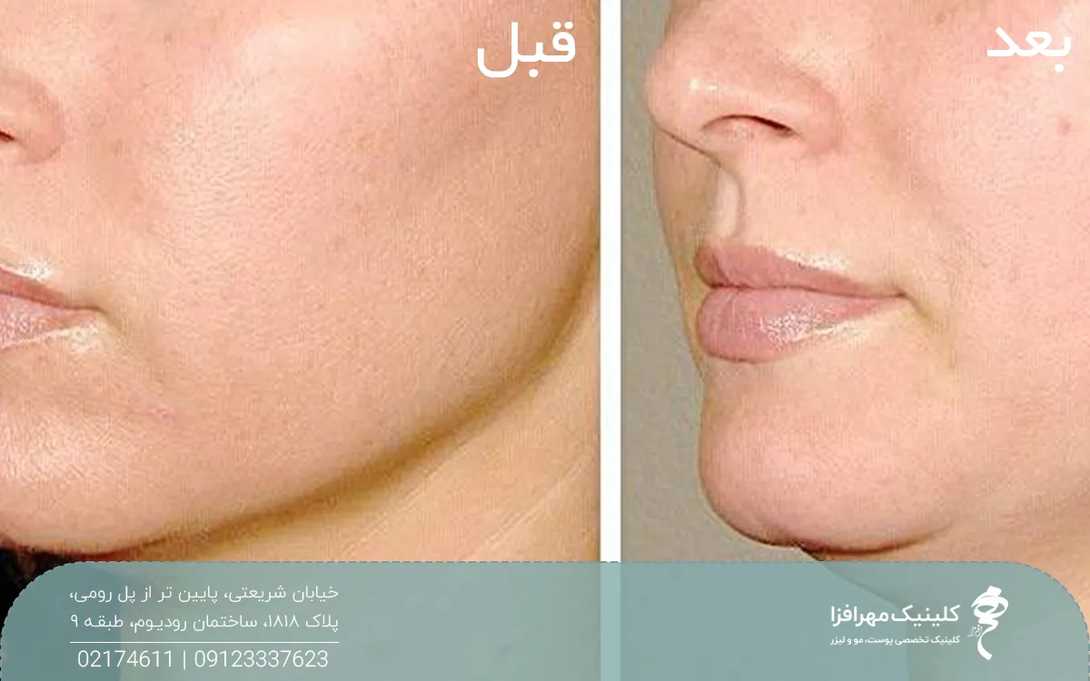 عکس قبل و بعد فردی که مزوژل جوانساز تزریق کرده است