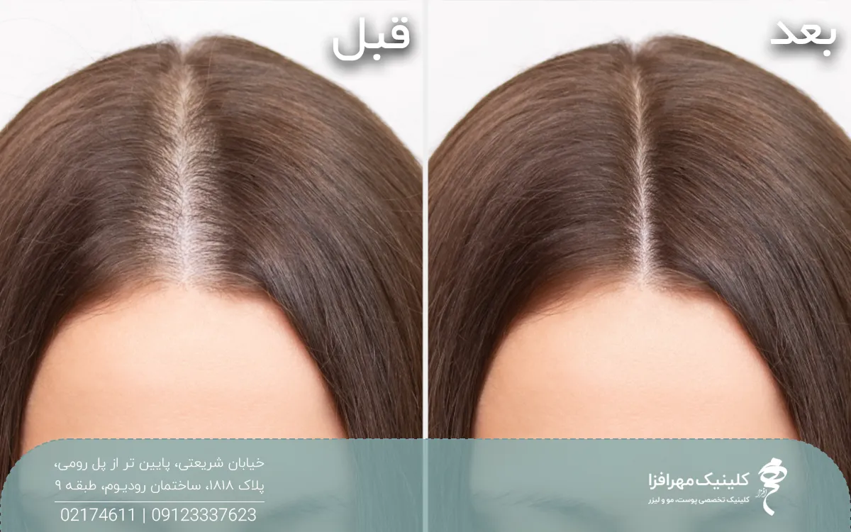 عکس قبل و بعد دختری که مزوتراپی مو انجام داده است