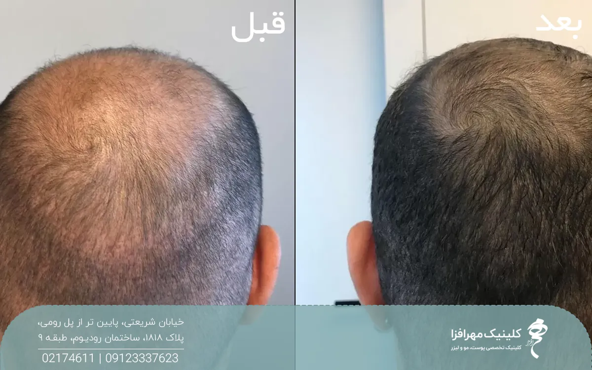 عکس قبل و بعد فردی که مزوتراپی مو انجام داده است