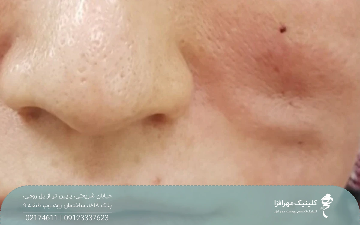 قسمتی از صورت فرد که روی گونه او دچار فرورفتگی شده است