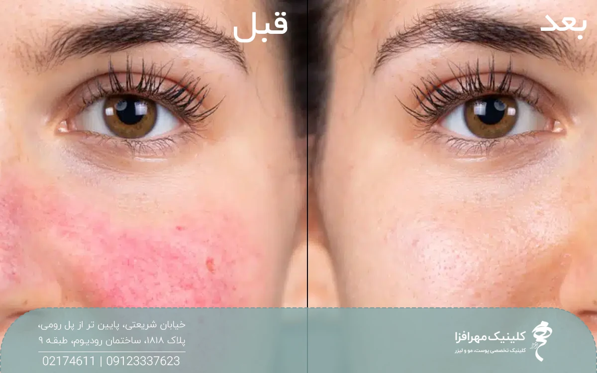 عکس قبل و بعد پی آر پی صورت دختر که باعث قرمز شدن گونه های دختر شده