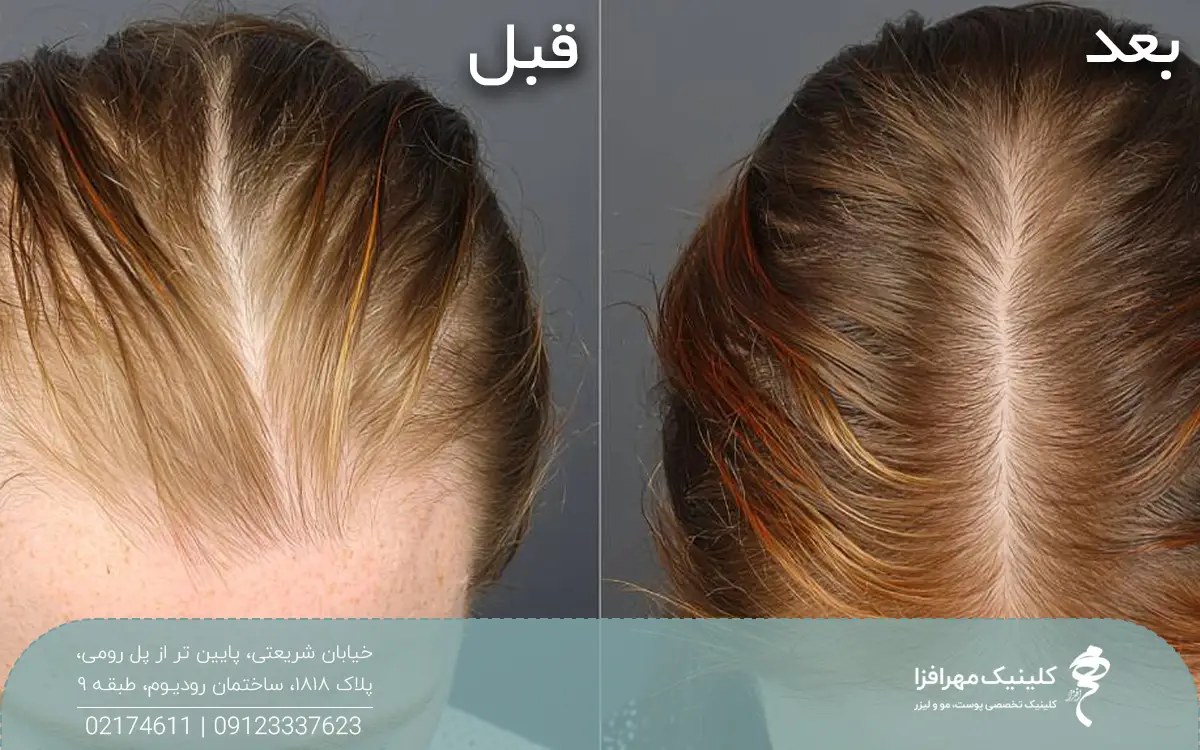 عکس قبل و بعد دختری که پی آر پی مو انجام داده است