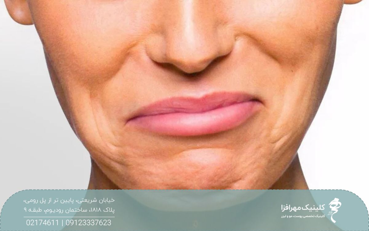 عکس از نیمه پایین صورت زن که لبخند زده است و چانه او سنگفرشی شده است