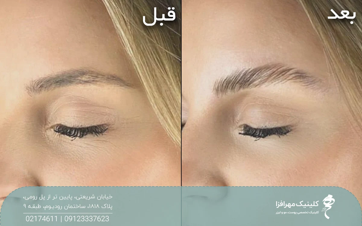 عکس قبل و بعد دختری که لیفت ابرو در منزل انجام داده است