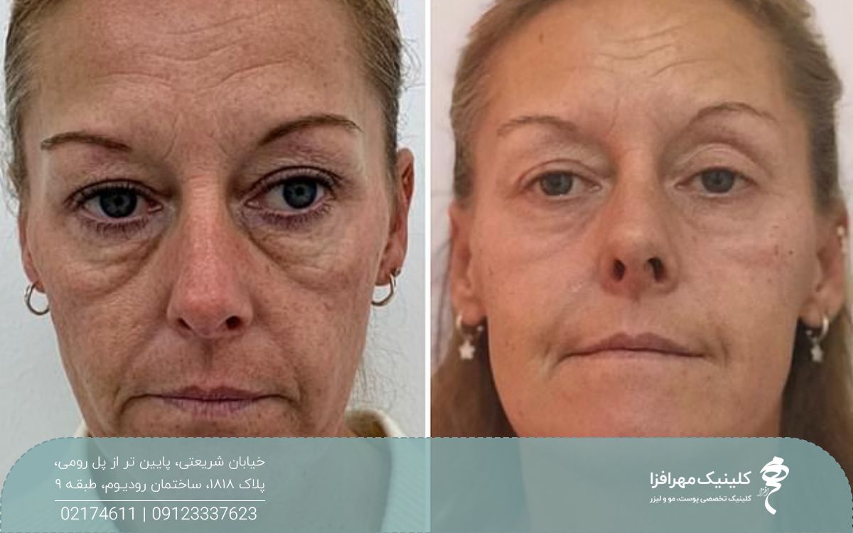 عکس قبل و بعد اندولیفت زیر چشم زن میانسال که چروک و افتادگی زیر چشم را رفع کرده است
