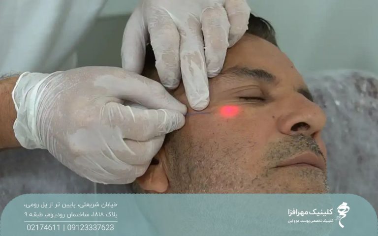 اپراتور در حال اندولیفت زیر چشم مردی که چشم های خود را بسته و صورتش را به یک سمت متمایل کرده است