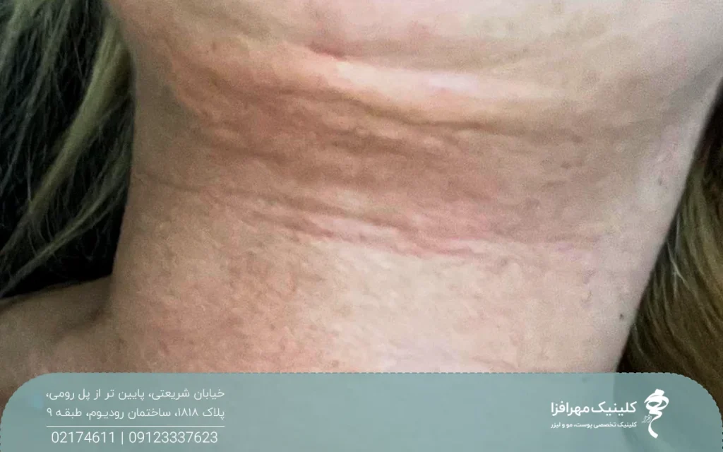 فردی که بعد از ساکشن غبغب دچار ناهمواری در پوست ناحیه گردن شده است