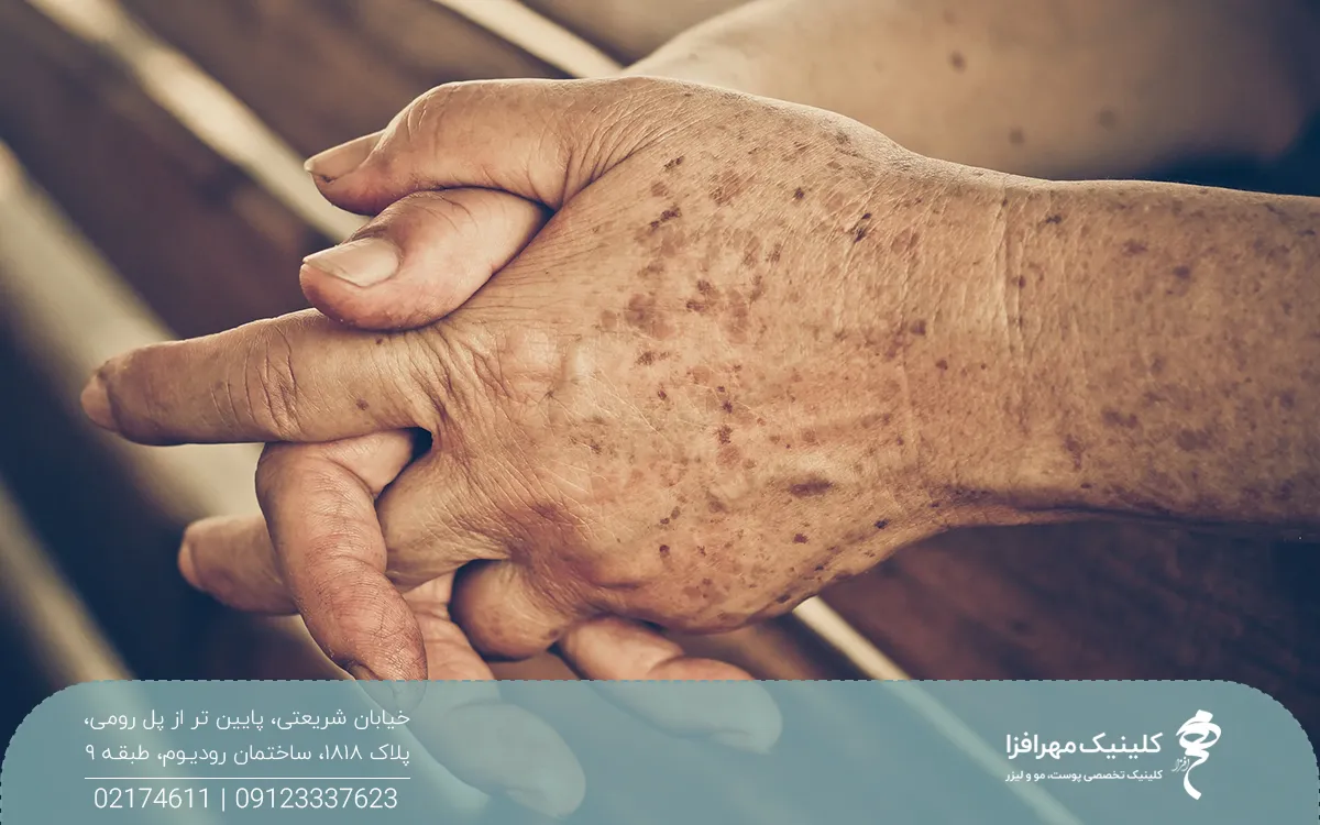 دستان فردی که انگشتانش در هم گره خورده است و روی دست هایش لکه های قهوه ای دارد