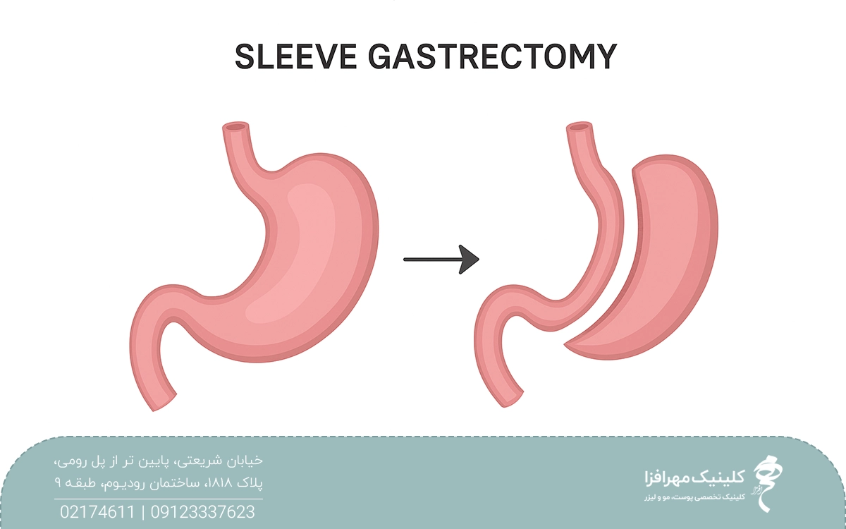 قبل و بعد معده که عمل اسلیو انجام شده است و روی عکس نوشته شده sleeve gastrectomy