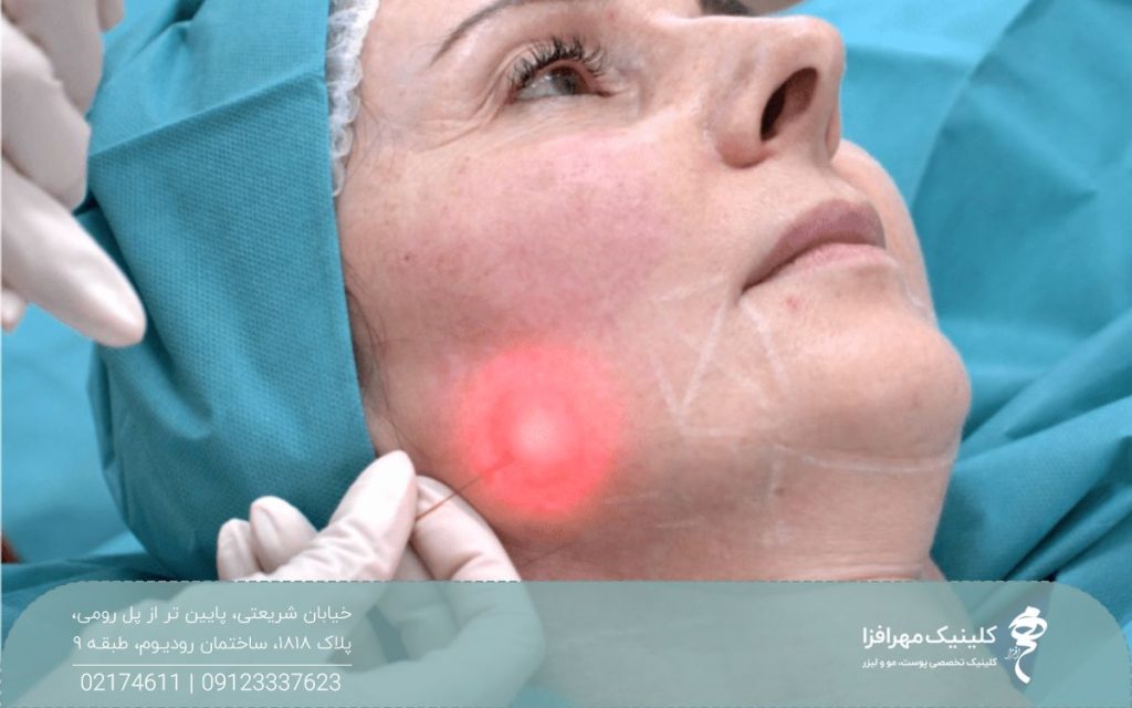 زنی که میکروفیبر اندولیفت زیر پوست او است و نور قرمز لیزر از زیر پوست او مشخص است