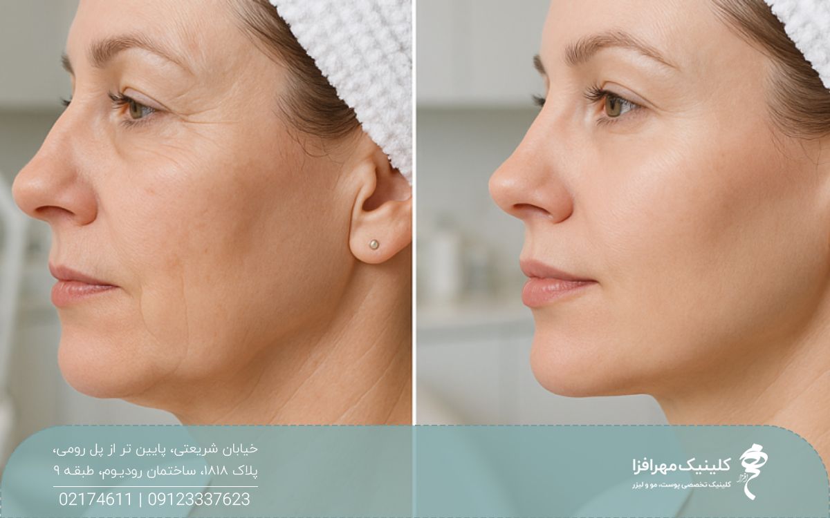 عکس قبل و بعد اندولیفت روی صورت زن که چین و چروک های صورت او را رفع کرده است