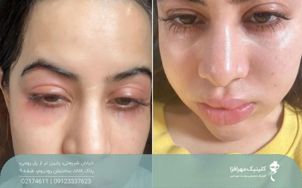 ۲ عکس از صورت دختری که بعد از تزریق چربی دچار ورم شدید شده است