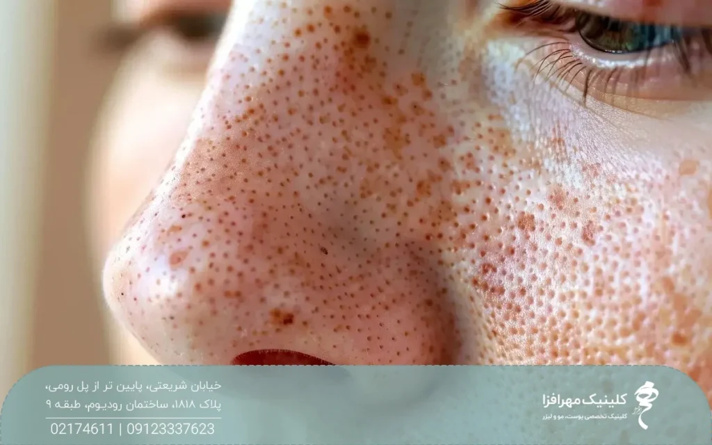 صورت دختری که منافذ باز بزرگی روی پوستش دارد