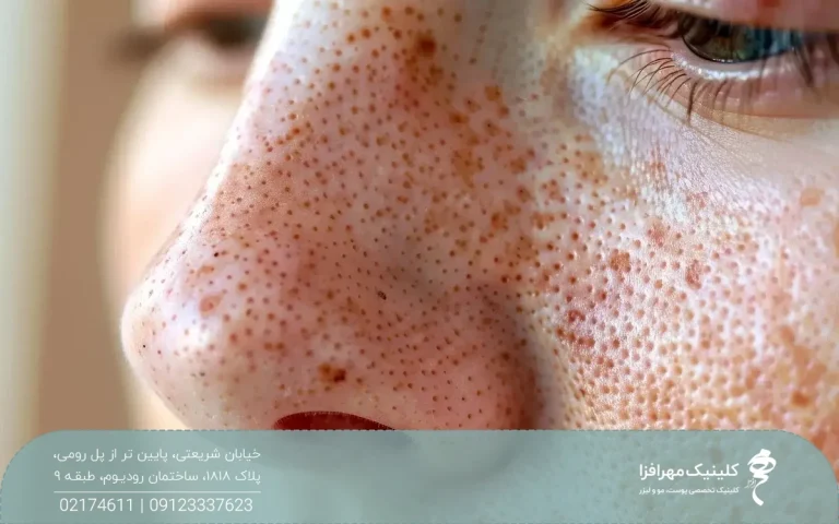 صورت دختری که منافذ باز بزرگی روی پوستش دارد