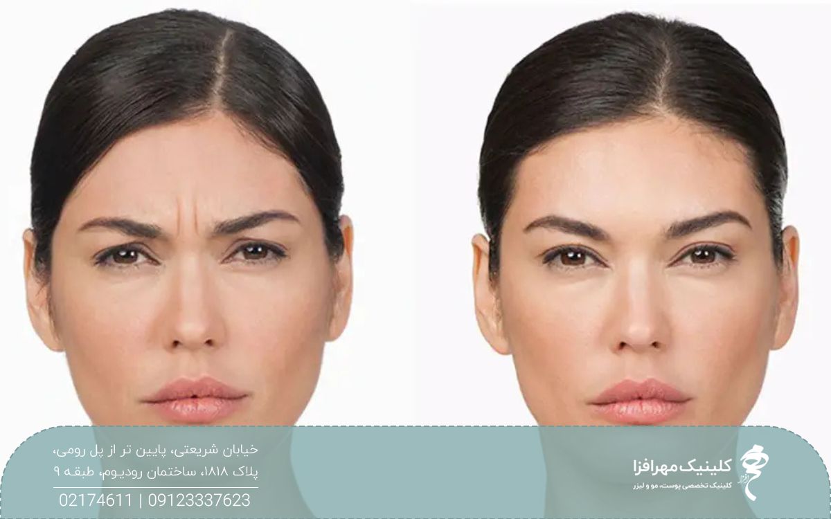 عکس قبل و بعد از تزریق بوتاکس به ابروی دختر