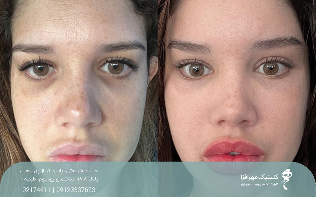 عکس قبل و بعد از تزریق چربی به زیر چشم دختر که باعث شده فرورفتگی زیر چشم او برطرف شود