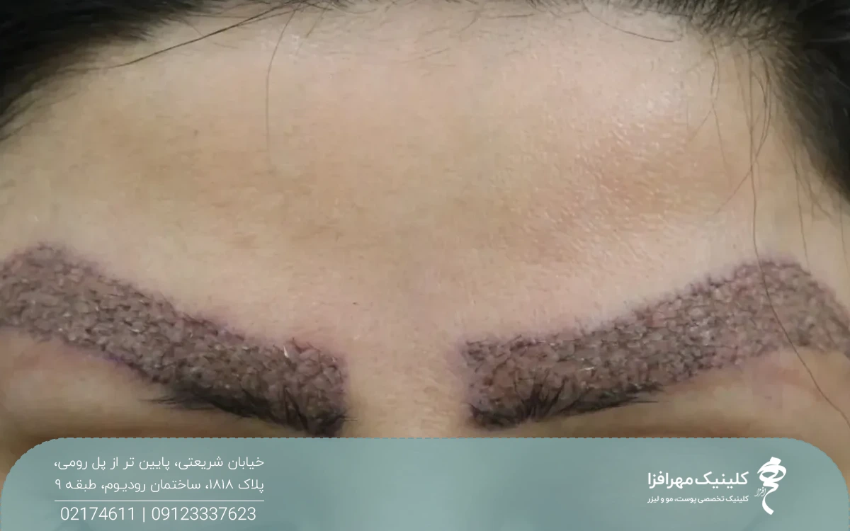 ابروهای فردی که تازه کاشت انجام داده است و ابروهای او زخم است