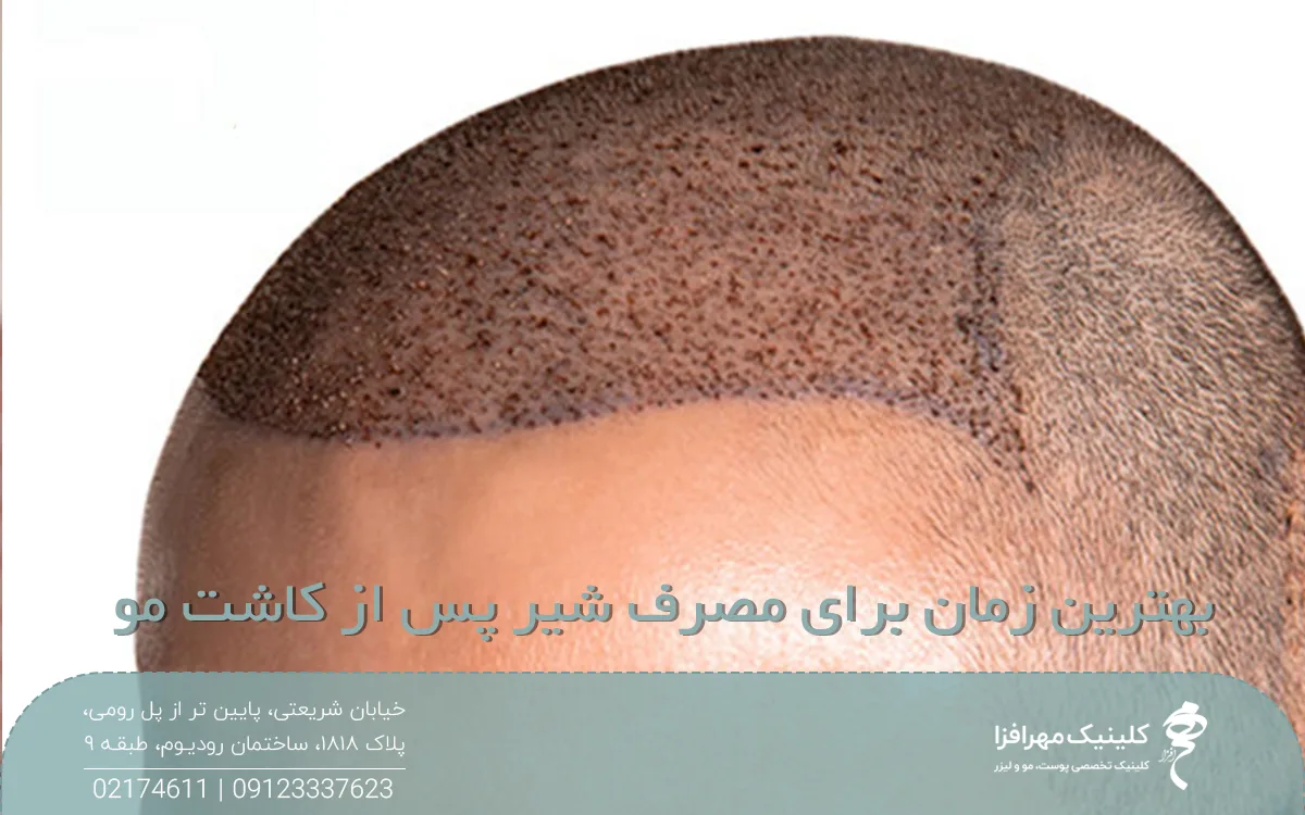 عکس سر مردی که به تازگی کاشت مو انجام داده است و روی عکس نوشته شده بهترین زمان برای مصرف شیر پس از کاشت مو