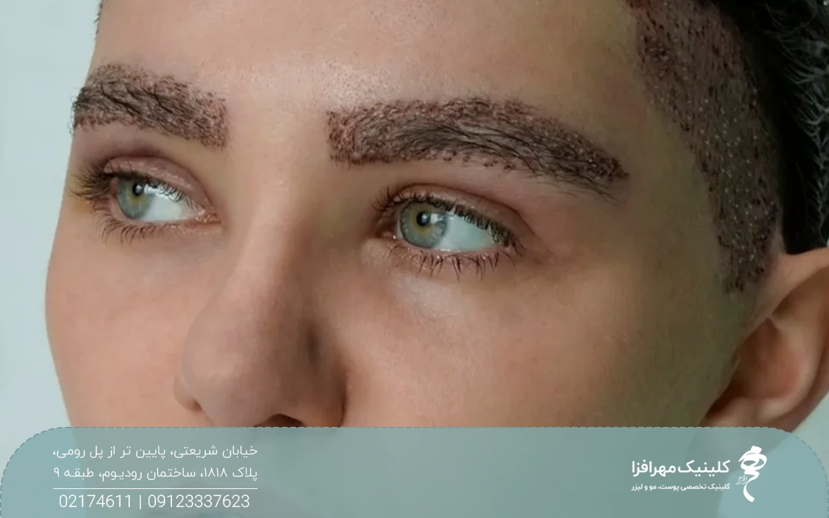 دختری که کاشت ابرو انجام داده و ابروهای او زخم است