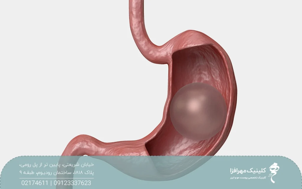 عکس از معده که داخل آن یک بالن قرار گرفته است