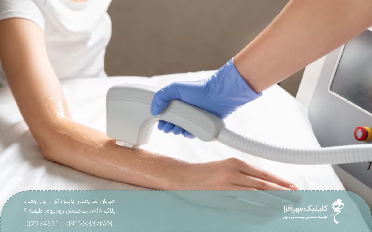 دست زنی که روی آن ژل زده اند و این ناحیه را لیزر می کند
