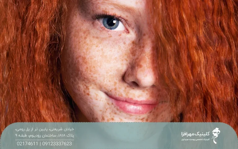 دختر با موهای قرمز که روی صورتش کک و مک دارد و موهایش روی یکی از چشم هایش ریخته است