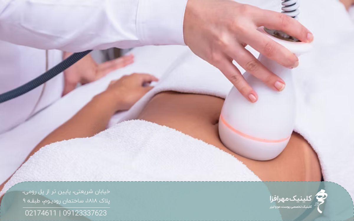 هندپیس دستگاه هایفوتراپی شکم که روی شکم دختر است