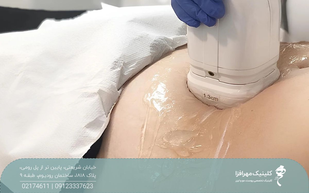 شکم دختری که اپراتور روی پوست او ژل زده و هندپیس دستگاه هایفو را در ناحیه شکم و پهلوی او حرکت می دهد