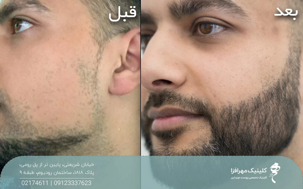 عکس قبل و بعد مردی که کاشت ریش و سبیل انجام داده است